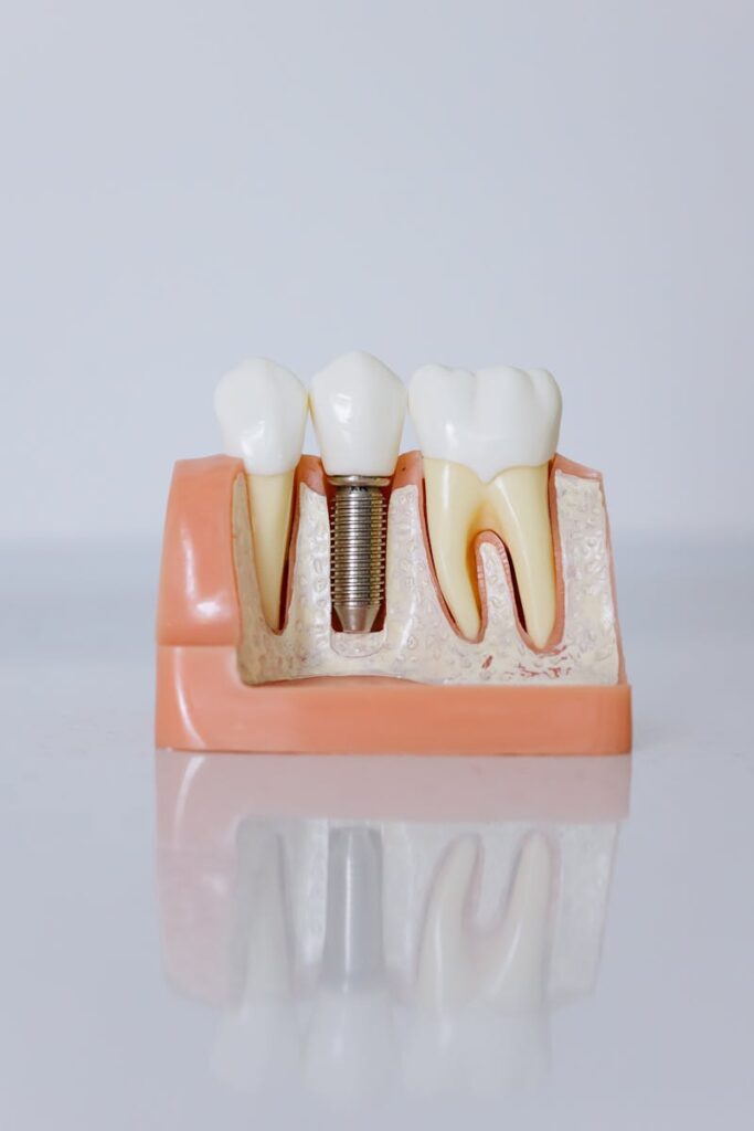 Tooth Implant