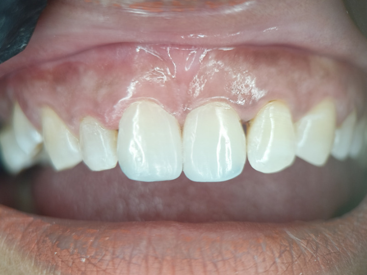 Dark Gums